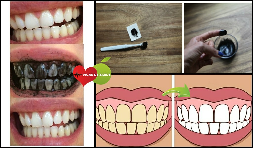 Clarear os Dentes 2