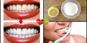 Como Clarear os Dentes