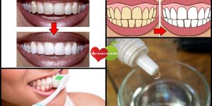 Como Clarear os Dentes 5