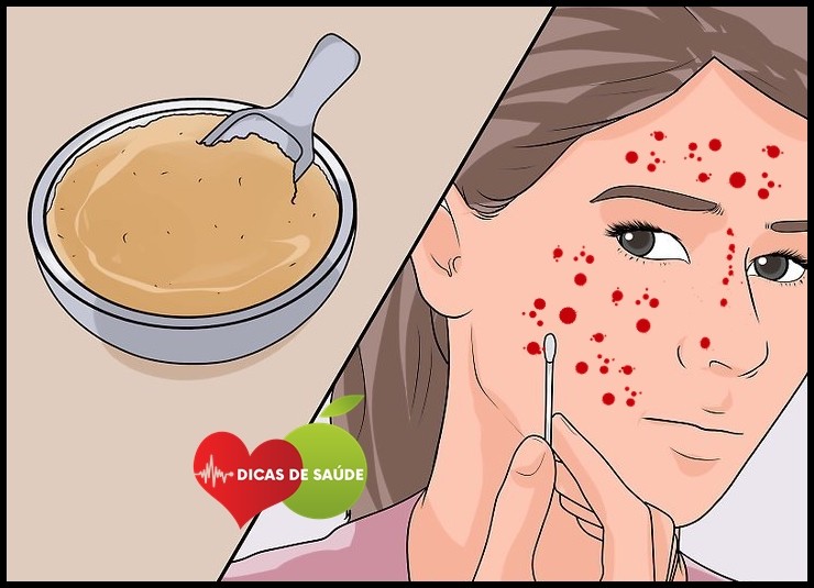 Como Eliminar a Acne em Casa