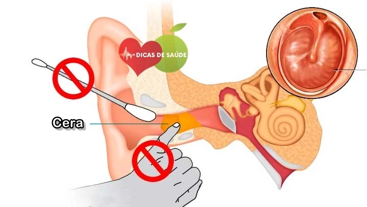 Como Limpar o Ouvido Corretamente