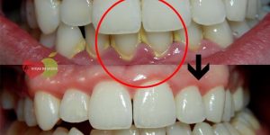 Como Remover a Placa dos Dentes em Apenas 1 Minuto-3