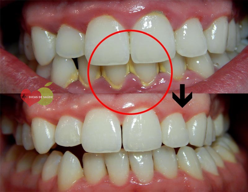 Como Remover a Placa dos Dentes em Apenas 1 Minuto-3