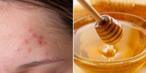 Como Tratar a Acne com Esta Receita Simples