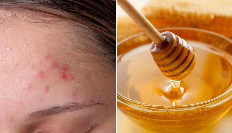 Como Tratar a Acne com Esta Receita Simples