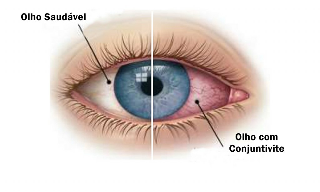 Conjuntivite