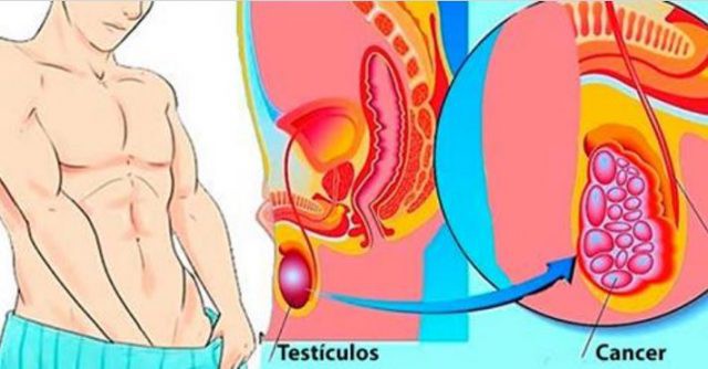 Câncer Testicular Sintomas e Prevenção