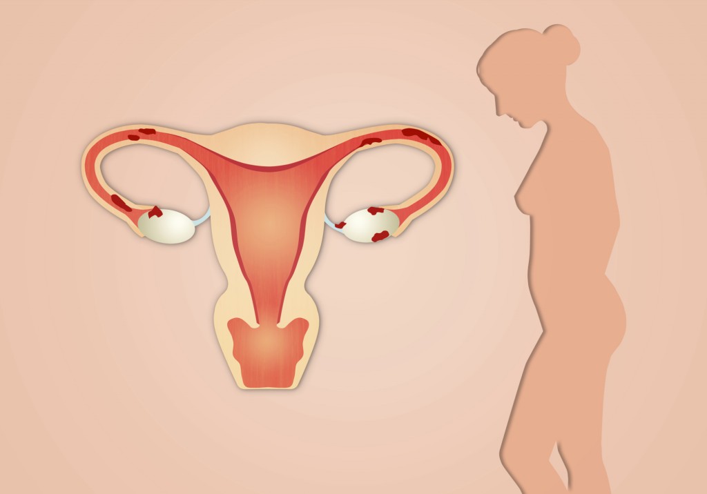 Sintomas da Endometriose