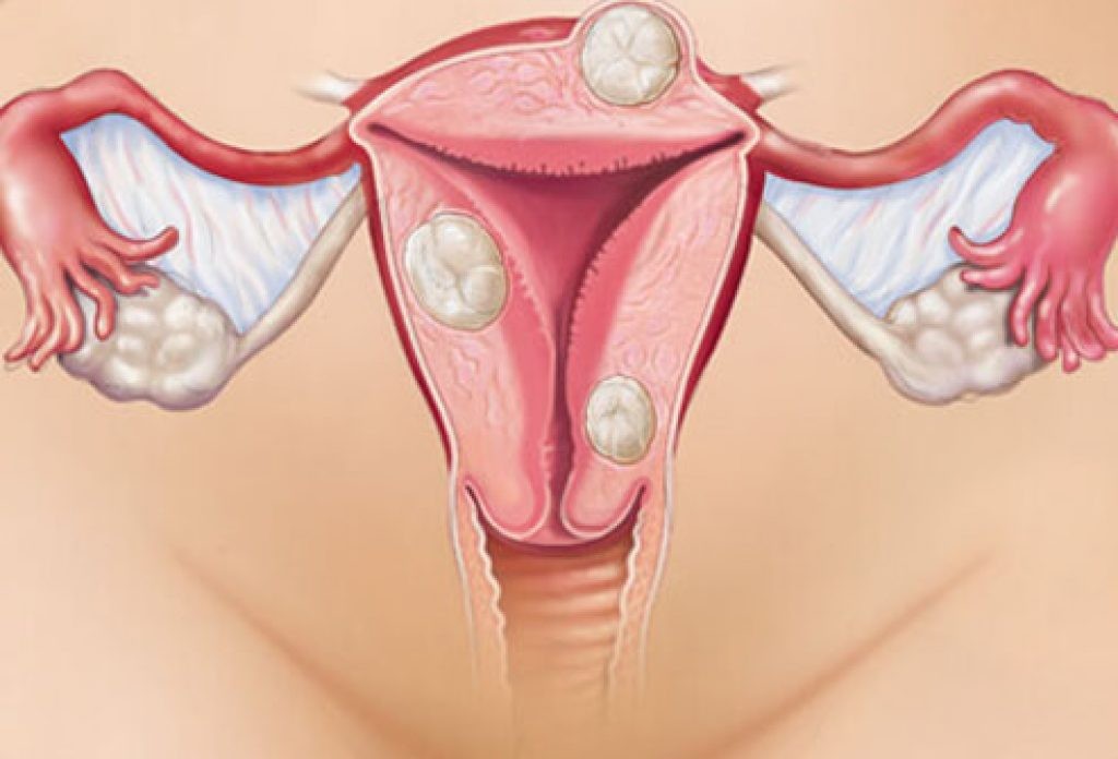 Endometriose 2