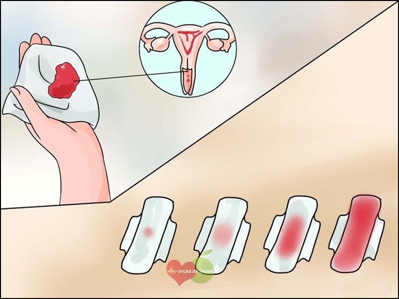 O que provoca uma hemorragia menstrual?