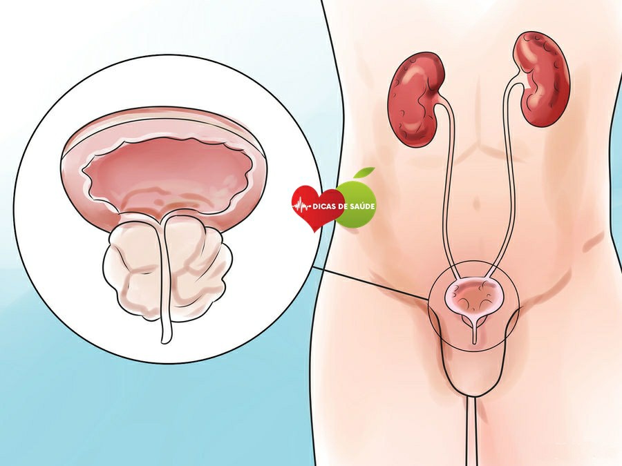 Infecção Urinária sintomas
