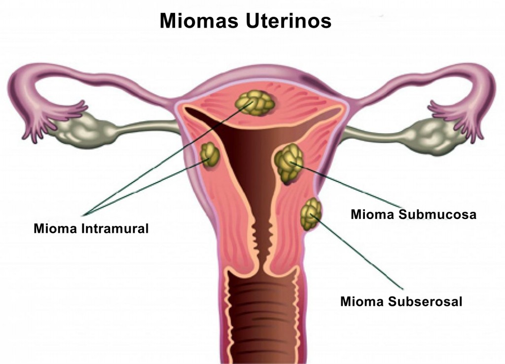 Miomas Uterinos Causas sintomas e Tratamentos