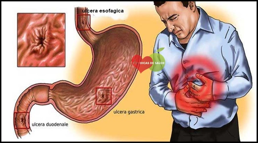 Sintomas da Gastrite Nervosa-1