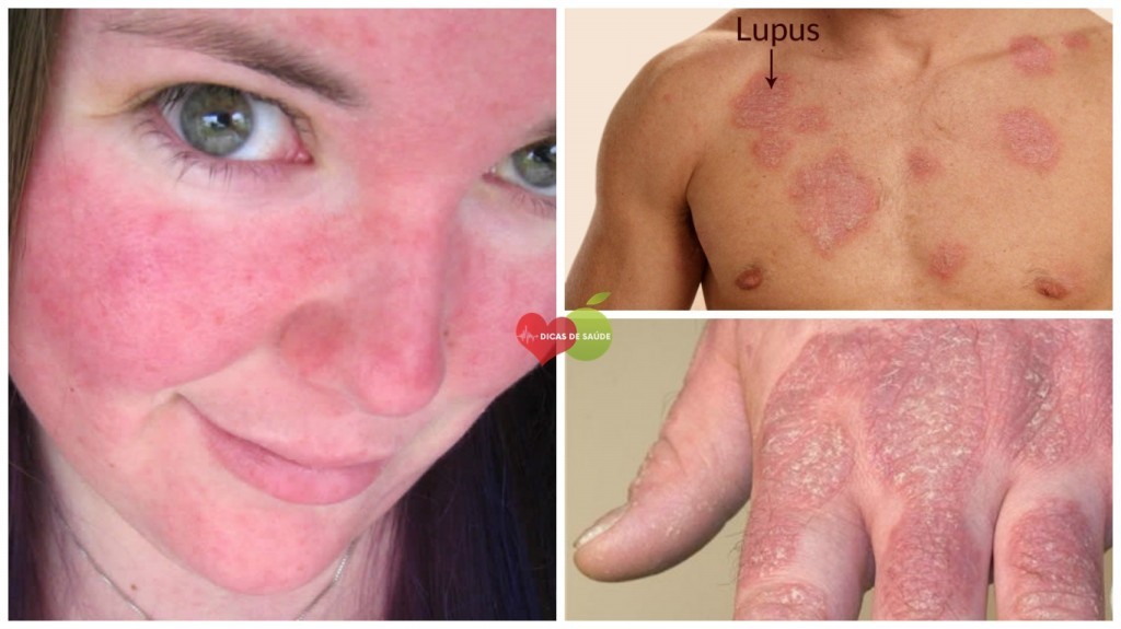 Sintomas de Lúpus