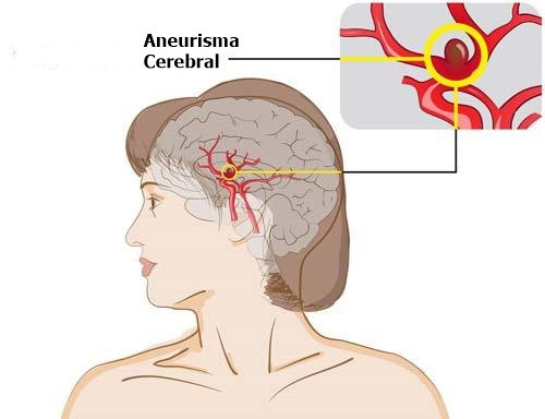 Os Principais Sintomas do Aneurisma Cerebral 1