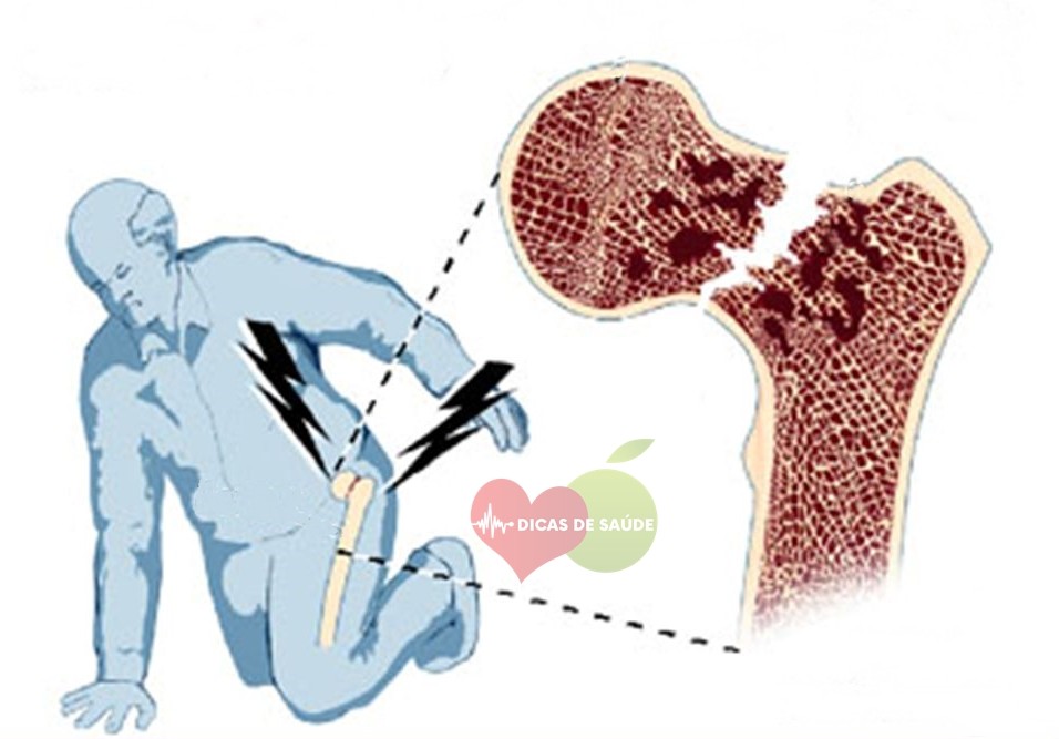 Previnem a Osteoporose 1