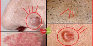 Sintomas de Câncer de Pele