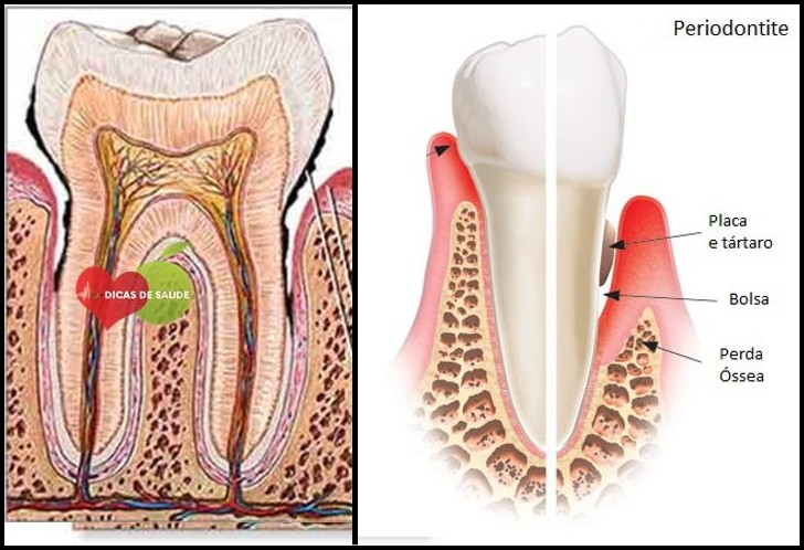 Receita Caseira Para Tratar Gengivite