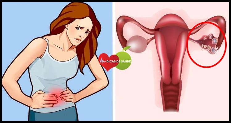 Sintomas-de-Cisto-nos-Ov%C3%A1rios Como se Produz a Menstruação e o Porquê das Dores