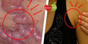 Principais Sintomas do HPV