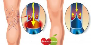 Como Eliminar as Varizes