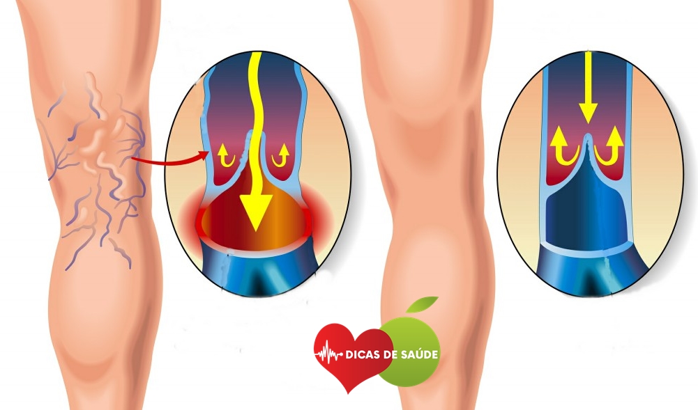 Tratar as Varizes nas Pernas