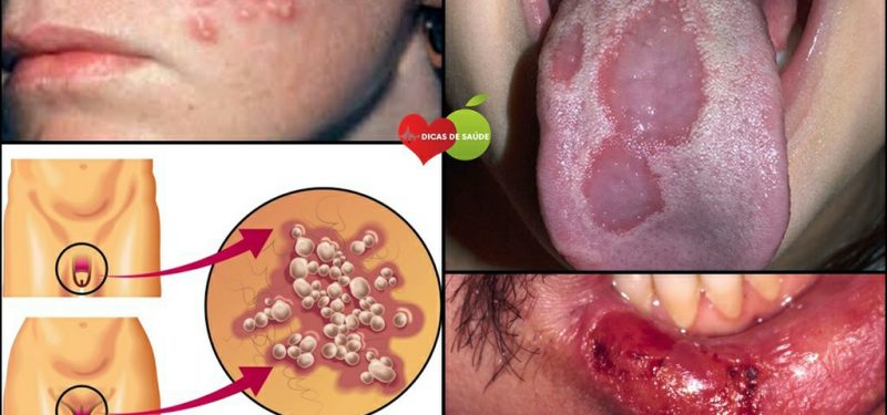 AIDS – O que é, Sintomas, Tratamentos e Causas