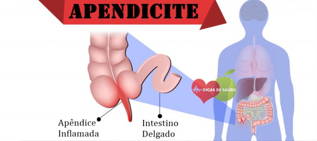 apendicite 2