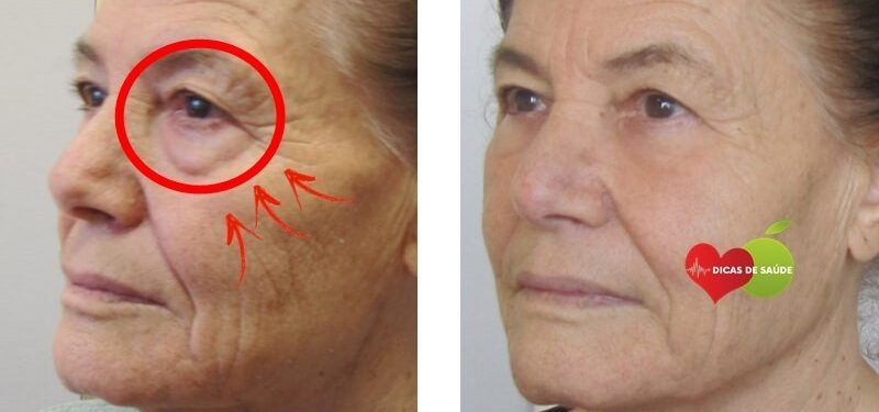 Acabe com o Inchaço e Bolsas ao Redor dos Olhos com Este Creme Caseiro!
