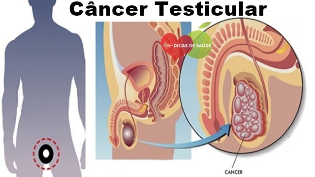 Sintomas de Câncer Testicular