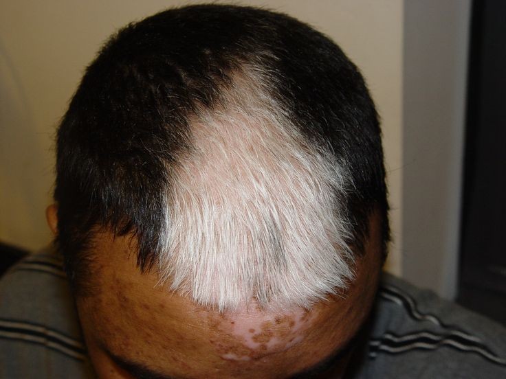 causas e tratamento do cabelo branco 1