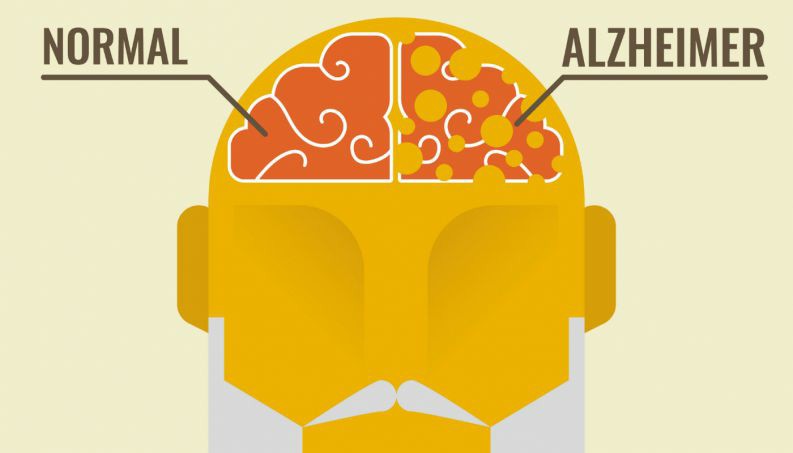 cerebro com alzheimer