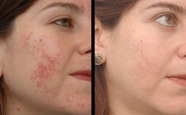 Como Reduzir as Cicatrizes de Acne