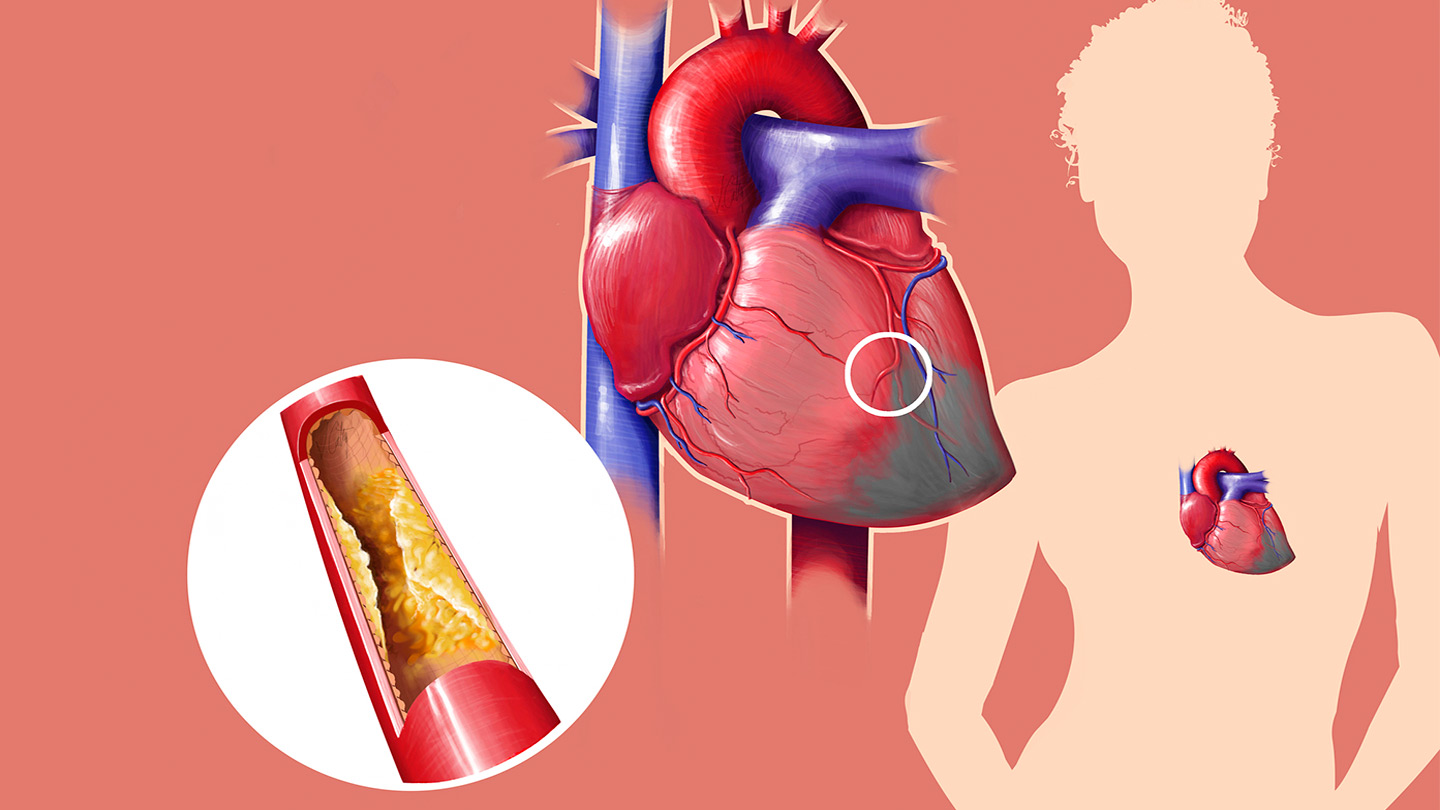 Dicas Para Baixar o Colesterol Naturalmente