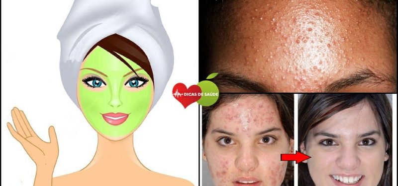 Como Tratar a Acne com Esta Receita Simples