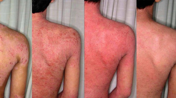 Dermatite e Como Aliviar