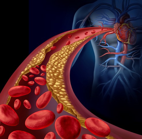 desentupir as arterias