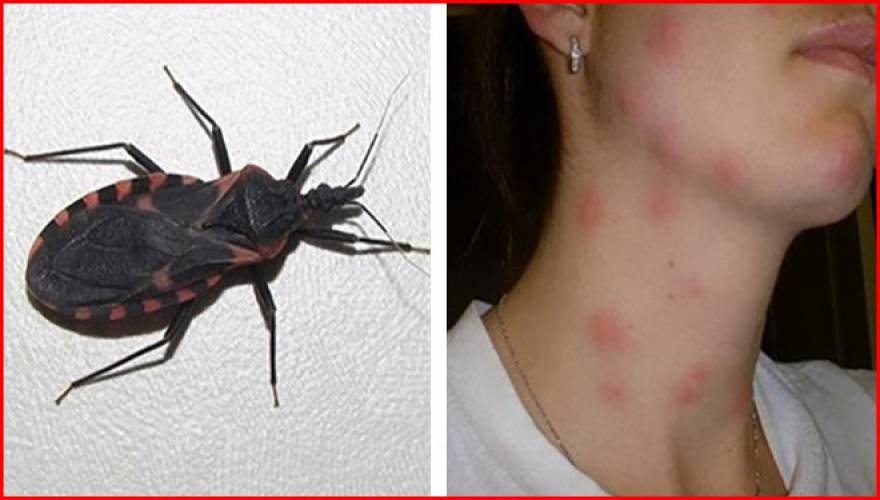 o que é Doença de Chagas