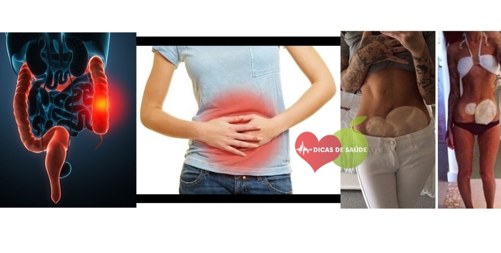 Sintomas da Doença de Crohn