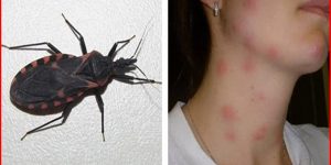 o que é Doença de Chagas