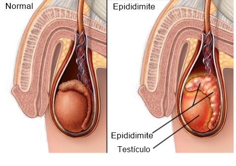 Principais Sintomas da Epididimite em Homens