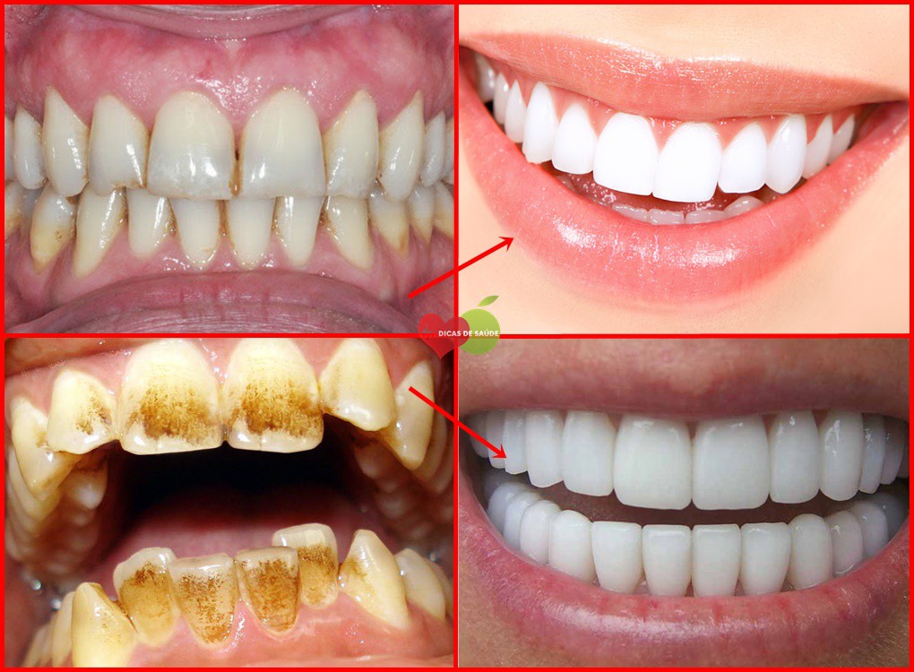 manchas nos dentes causas e tratamentos 1