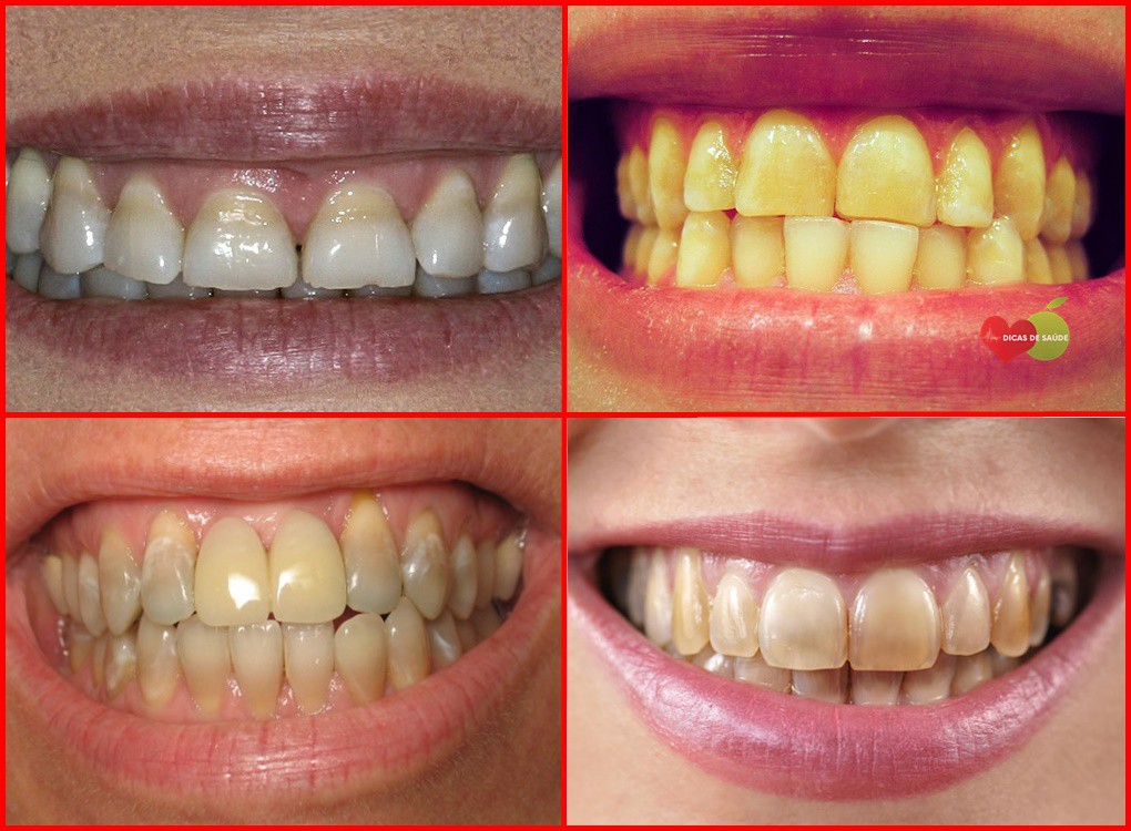 manchas nos dentes causas e tratamentos