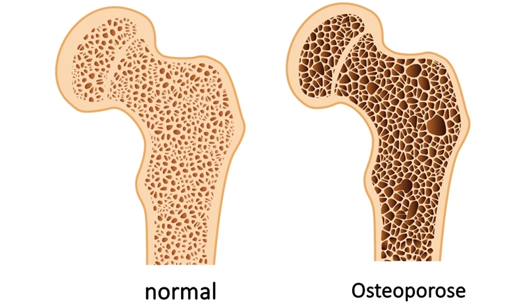 osteoporosis 1