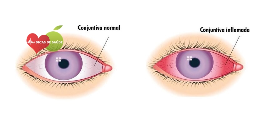 Receita Caseira Eficaz Para Aliviar Conjuntivite