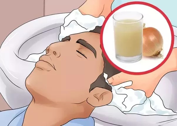 suco de cebola para caspa 1