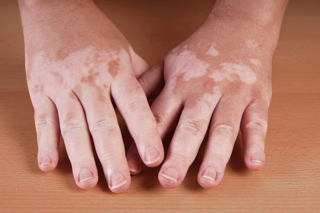 Causas do Vitiligo