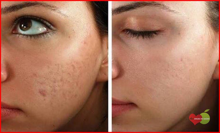 Receitas Caseira Para Acabar com Acne