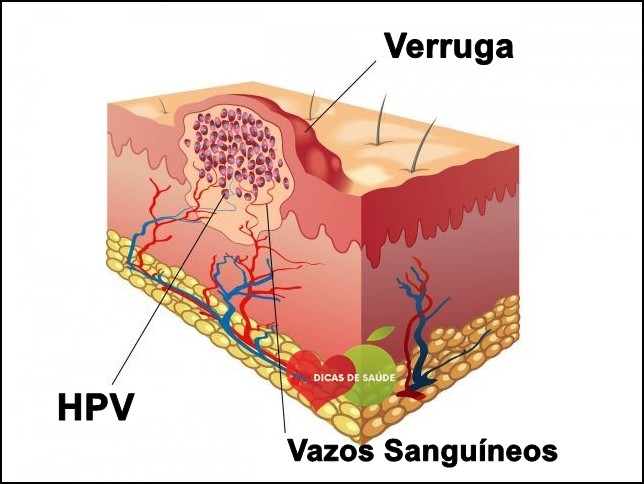 As 3 Receitas Caseiras Para Eliminar Verrugas