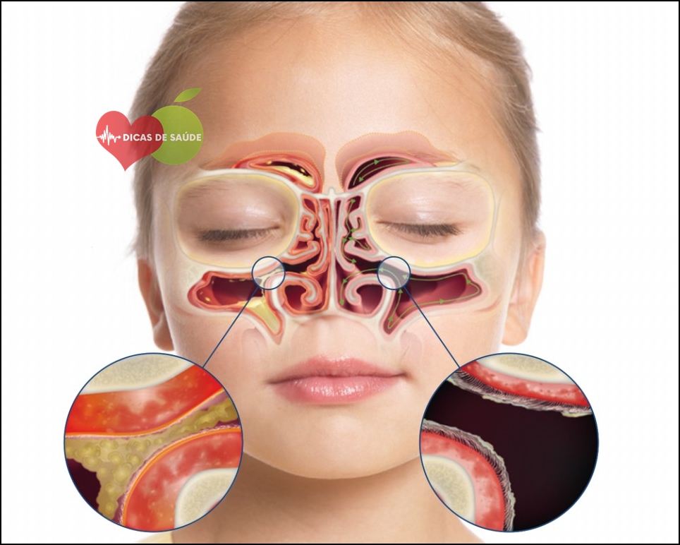 As Dicas Para Tratar Sinusite em Casa